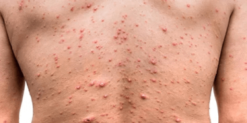 Se confirma el primer caso de viruela del mono en Argentina