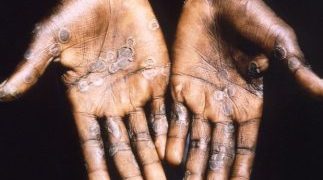 Haití investiga un caso sospechoso de la viruela del mono