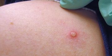 OMS declara la viruela del mono como emergencia sanitaria internacional